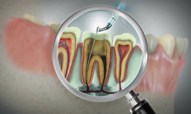 Best Root Canal Treatment in Bhayandar, Mumbai